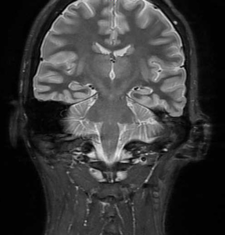 MRI＿ Image144