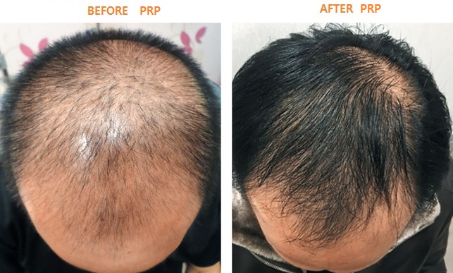 PRP hair transplant in Dubai